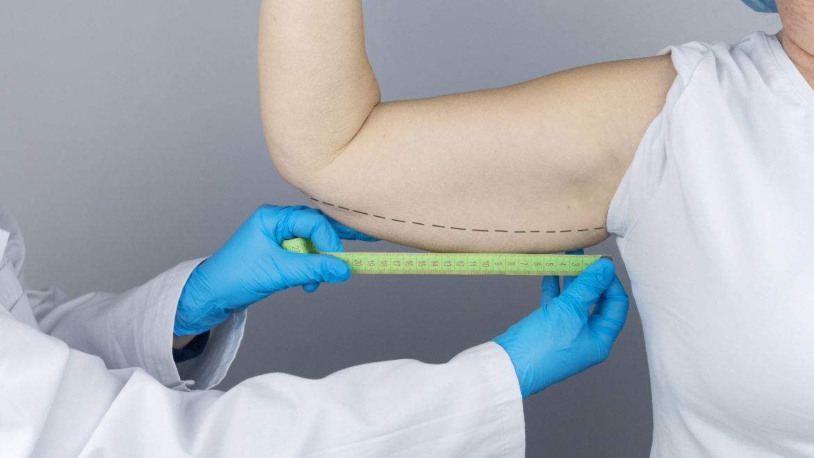 6 Factors You Should Consider for an Arm Lift Procedure