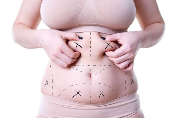 Tips for Fast Recovery from Vaser Liposuction Surgery