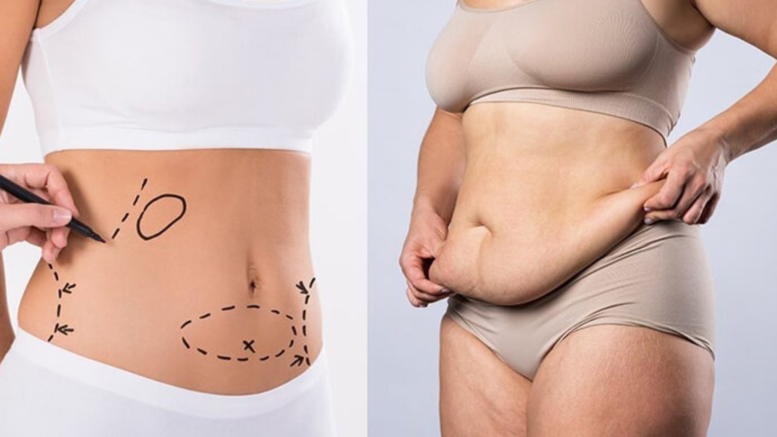 Liposuction Uncovered: Fat Loss or Weight Loss?