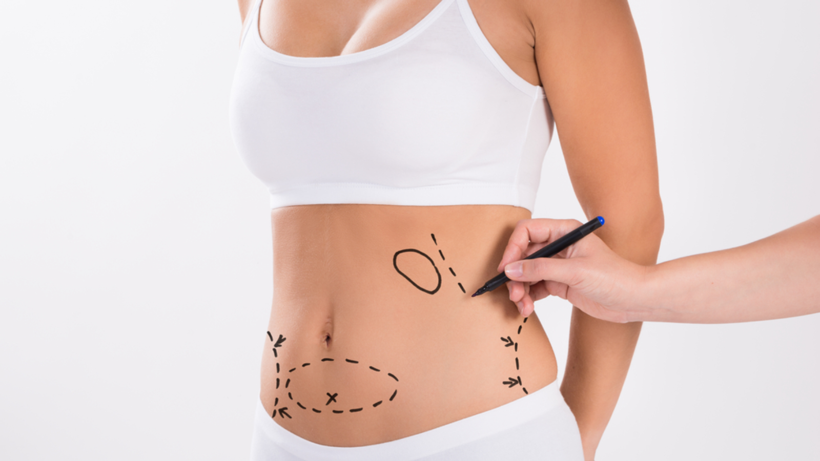 Is Liposuction Permanent? Discover How to Maintain Your Sculpted Look