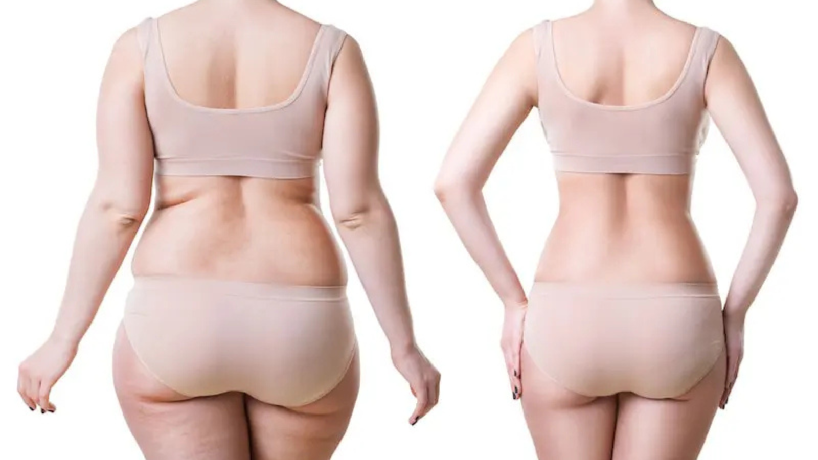 Liposuction Recovery Timeline: When Will You See Results?