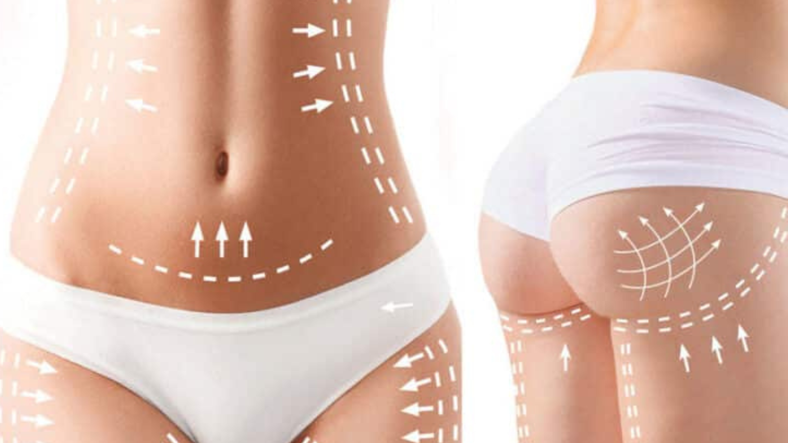 Sculpt Your Dream Body: Top Liposuction Areas to Transform Your Look