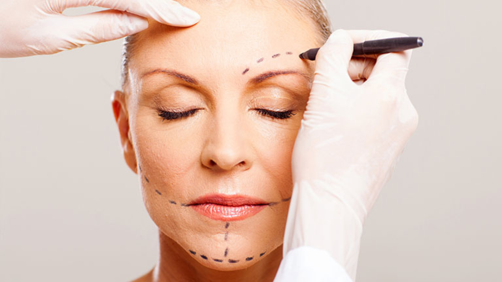 MACS Lift vs Traditional Facelift Compare Results & Downtime