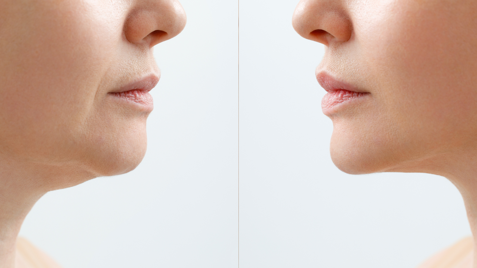 Buccal Fat Removal vs Cheek Liposuction – Best Choice?