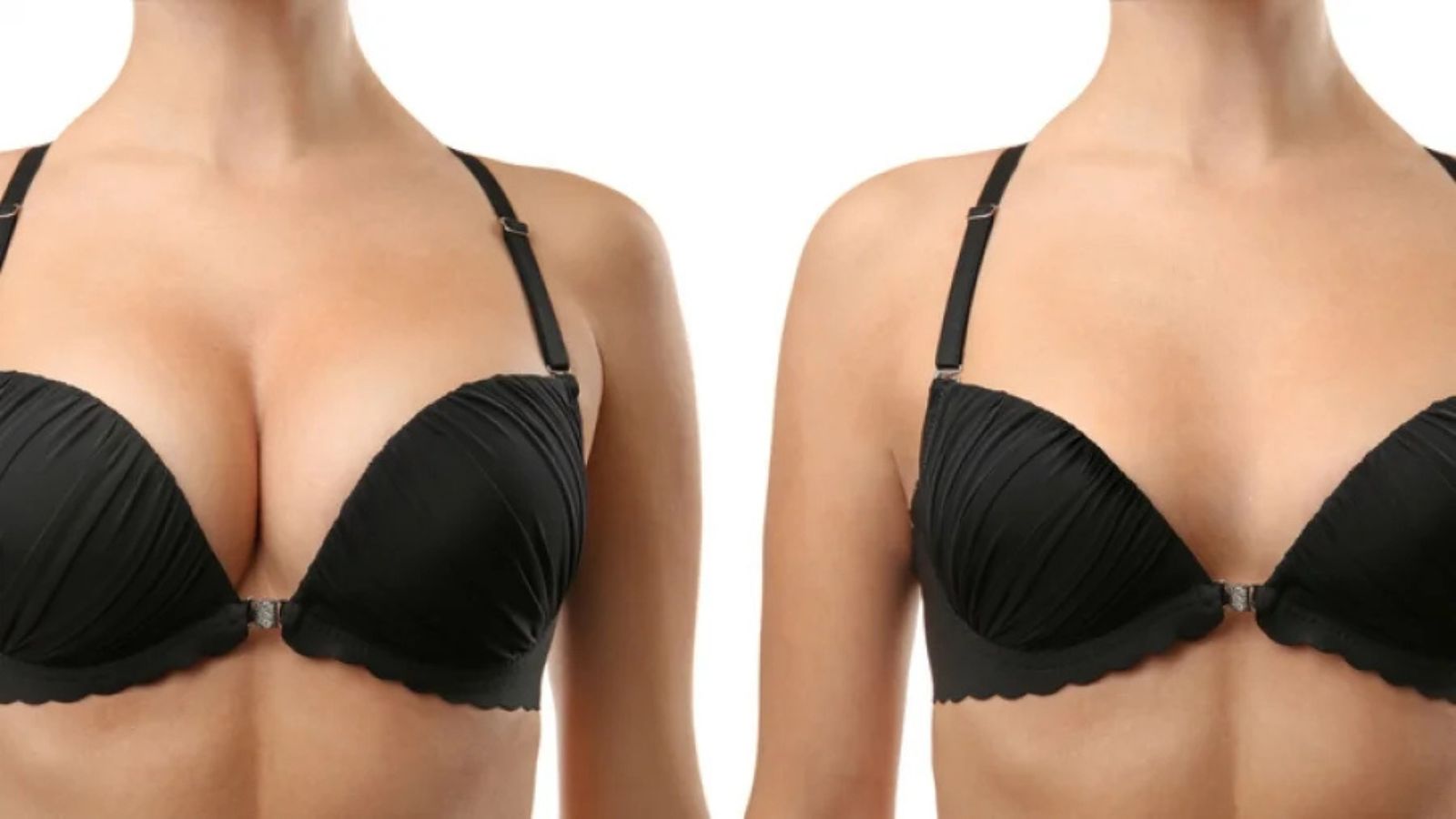 Can Breast Reduction Improve Back and Neck Pain