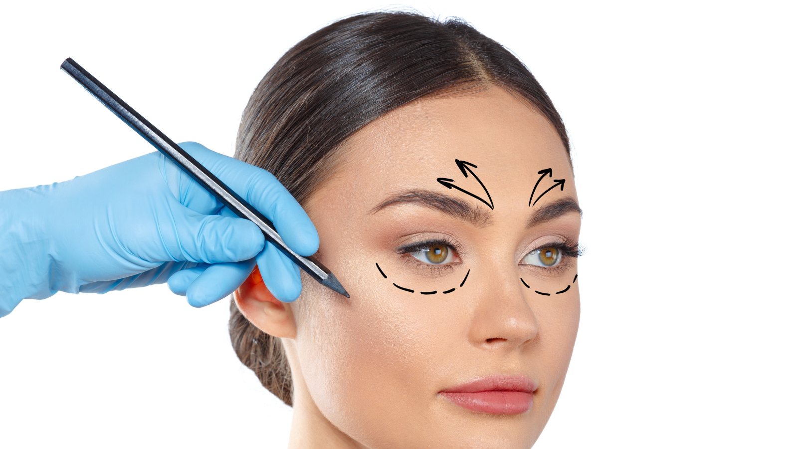 MACS Lift + Eyelid Surgery: Instant Youthful Results