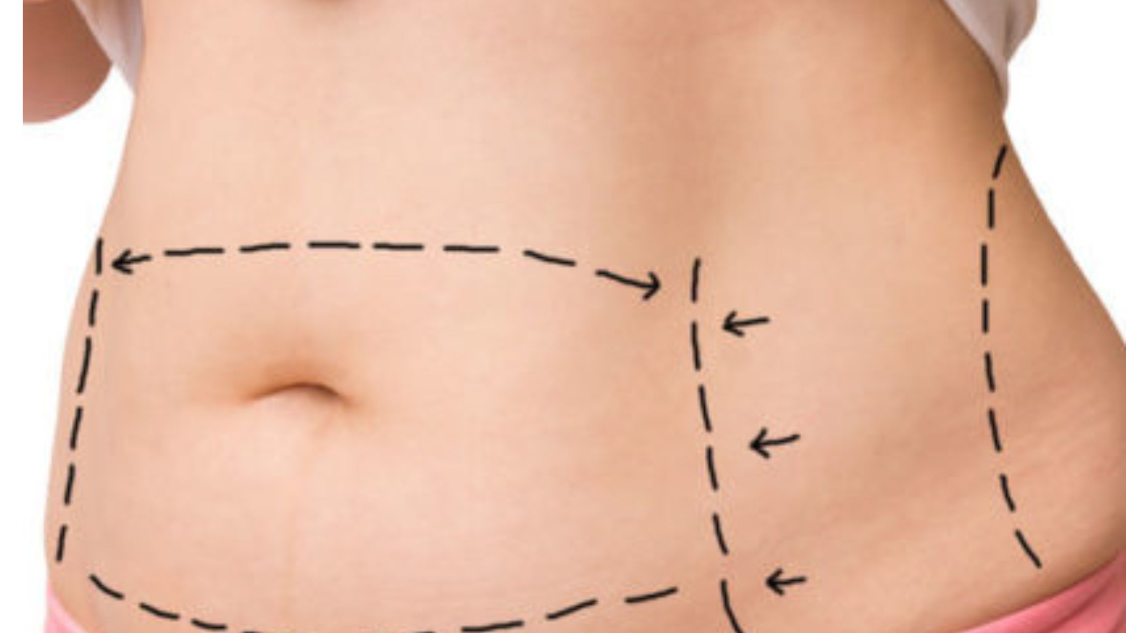 Top Things to Know Before a Mommy Makeover Surgery