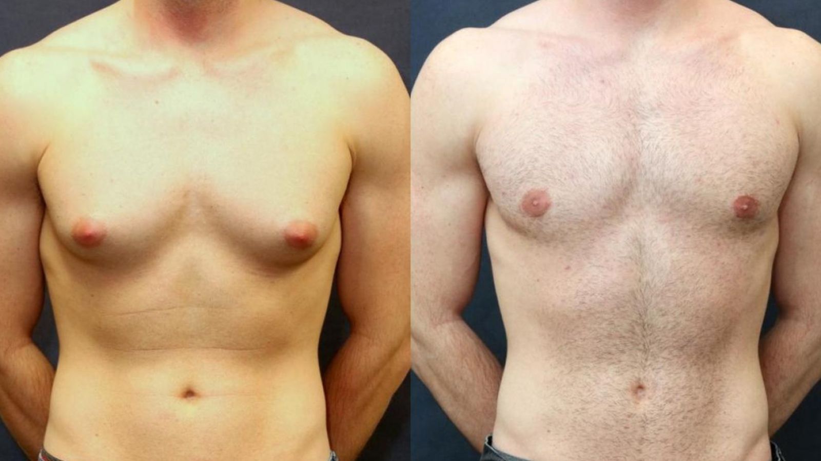 Top Post-Surgery Care Tips for Gynecomastia Do’s and Don’ts You Must Follow
