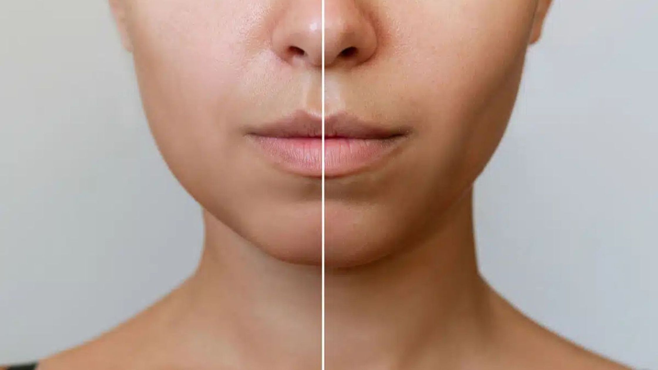 Buccal Fat Surgery: Top 5 Concerns Explained