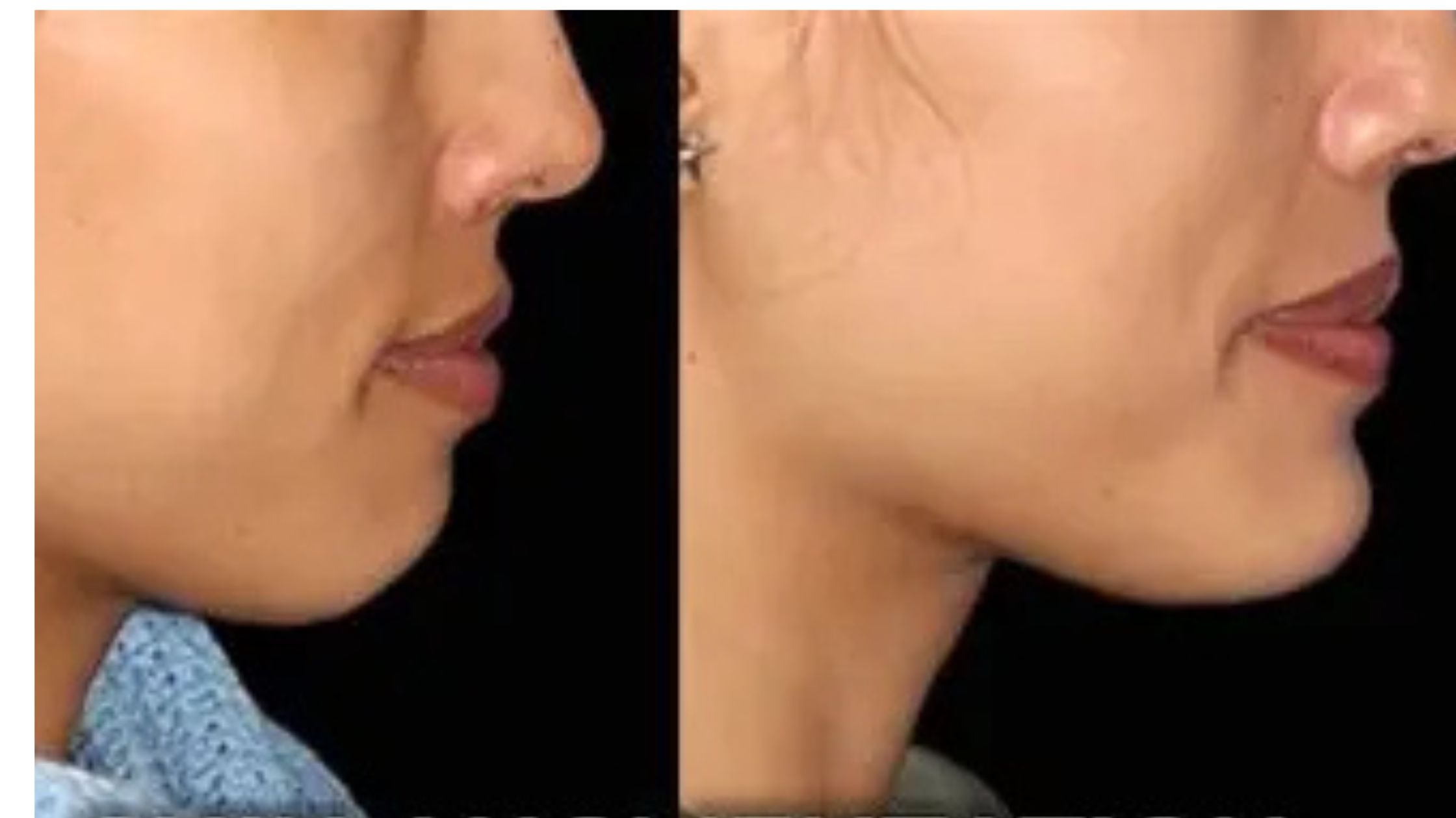 Chin Implants vs Fat Grafting: Best Augmentation Guide