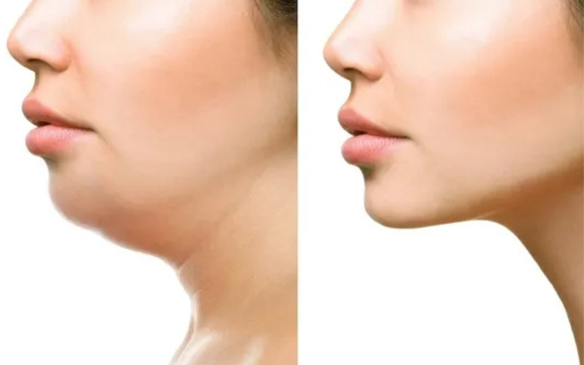 Can Jawline Surgery Fix Facial Asymmetry? Expert Guide