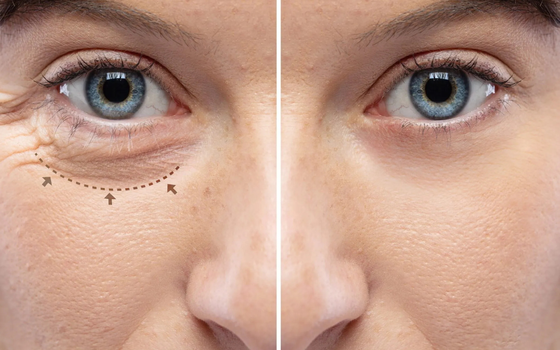 Eyelid Surgery (Blepharoplasty) Benefits, Procedure, Recovery & Results