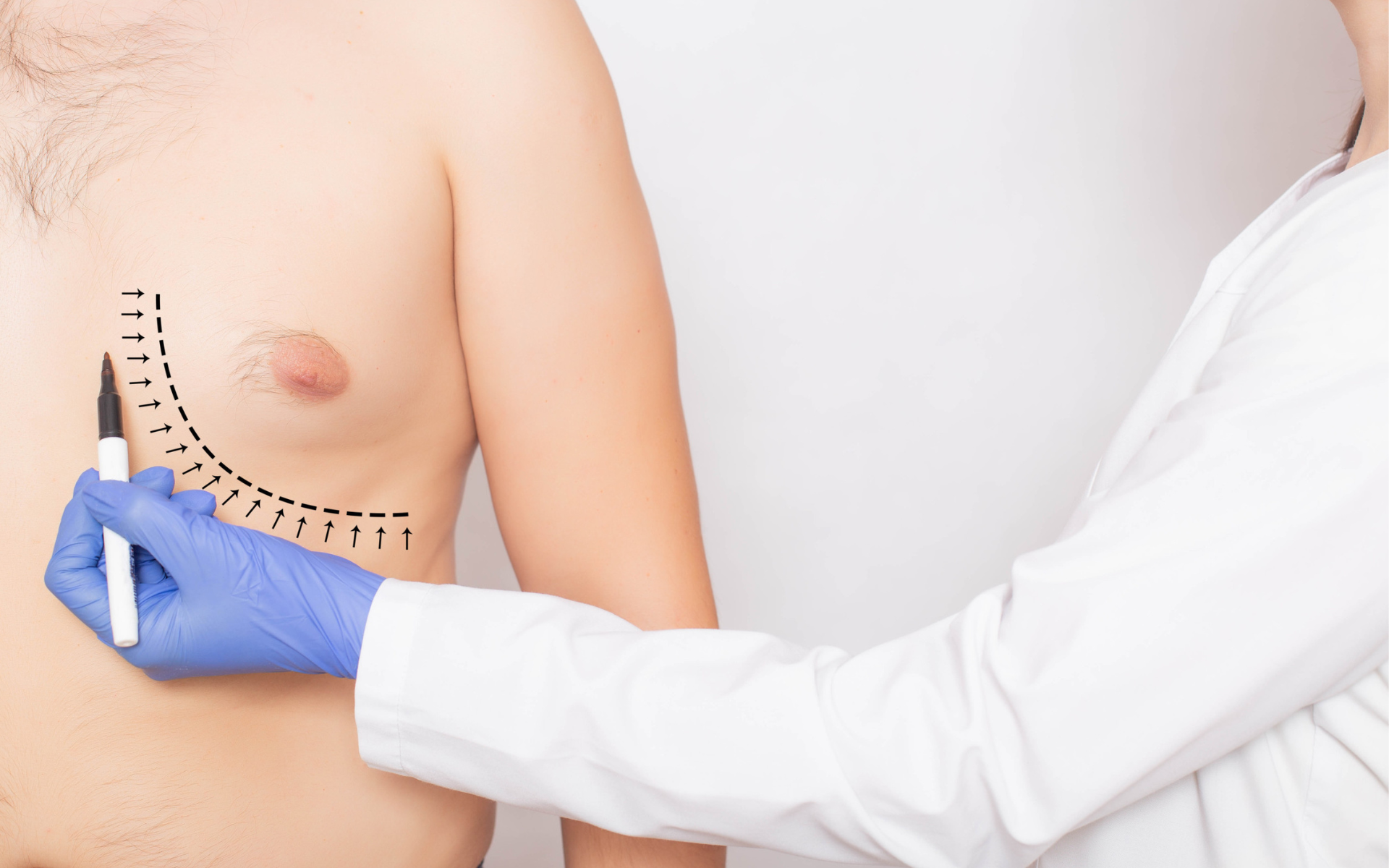 Gynecomastia Surgery Causes, Treatment Options & Recovery Guide