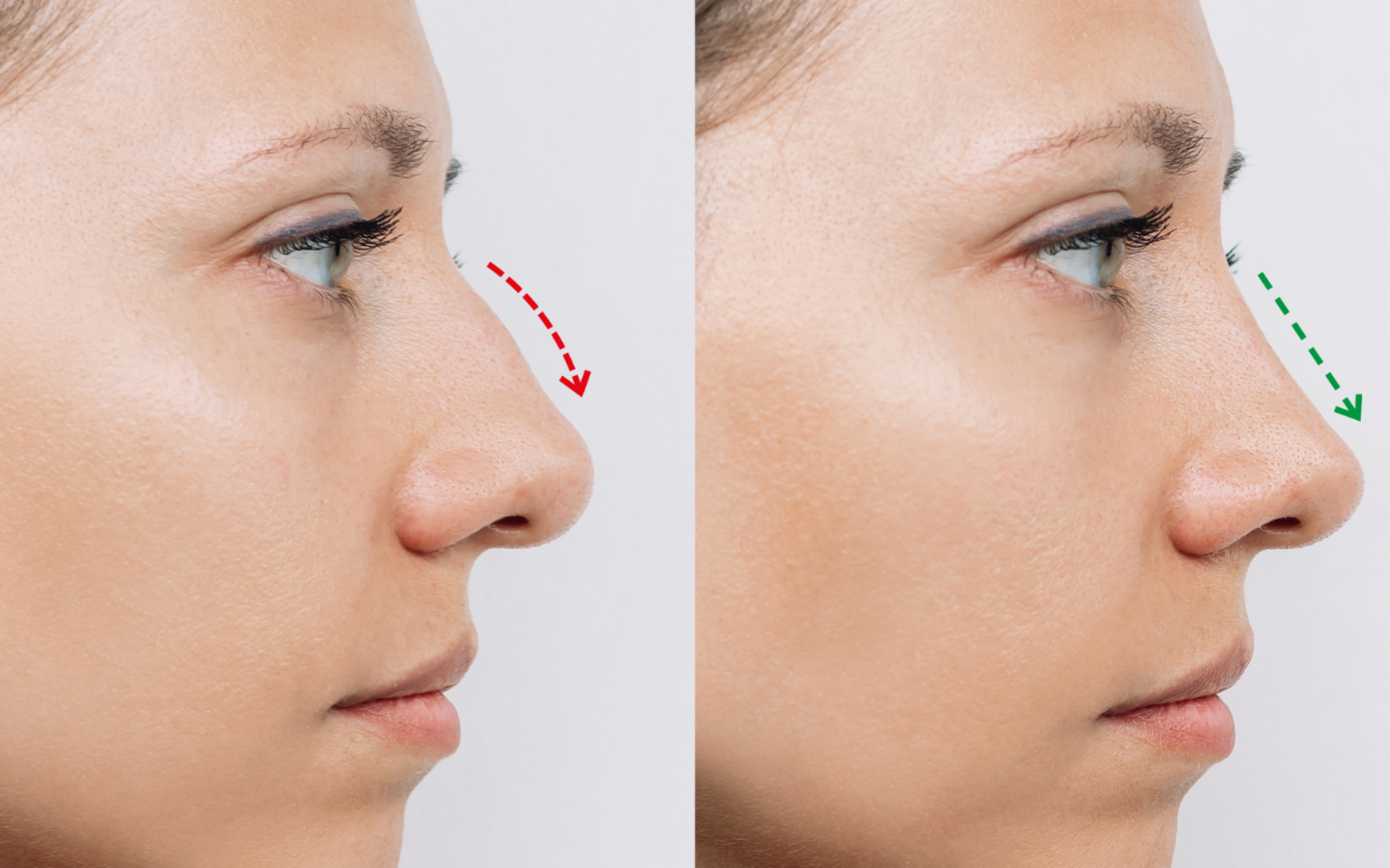 Rhinoplasty Surgery Nose Reshaping for Better Face Balance & Breathing