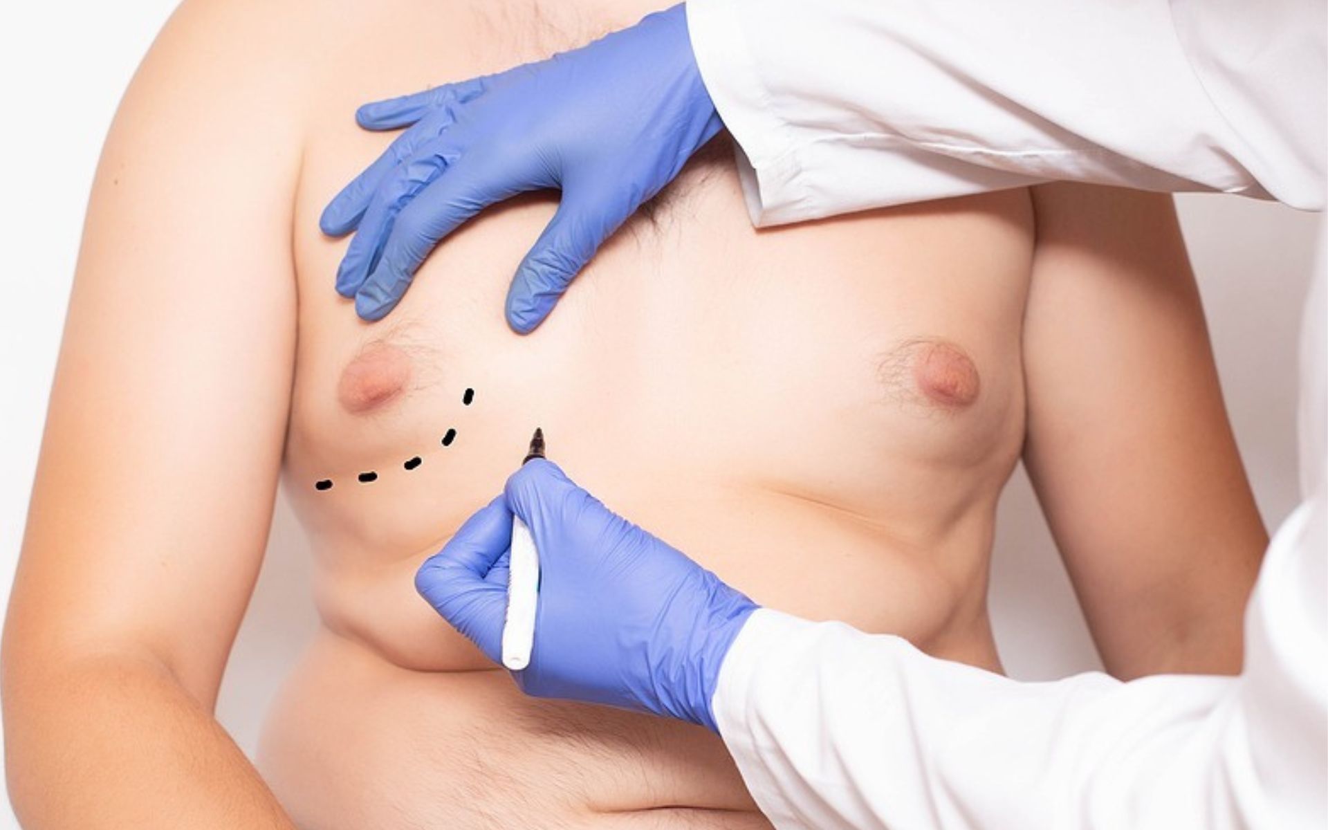 Gynecomastia vs Chest Fat Causes, Differences & Treatment Options