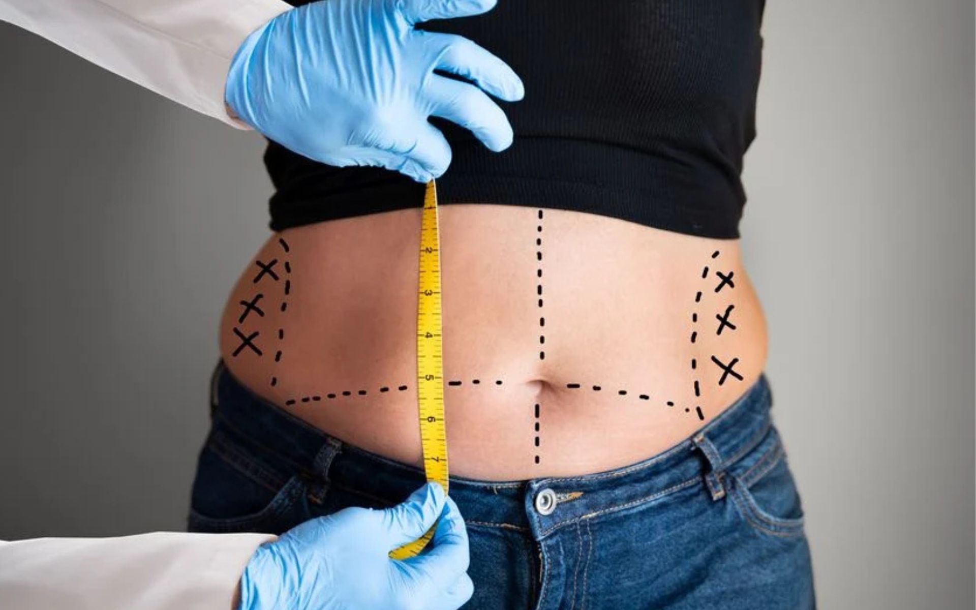 Mommy Makeover Surgery Procedures, Benefits, Recovery & Results