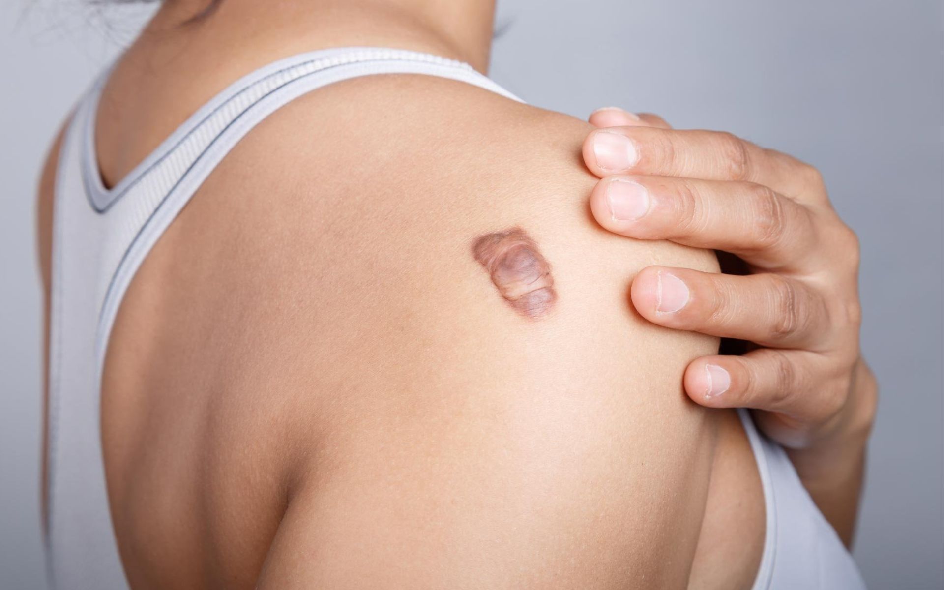 Scar Revision Surgery Treatment Options, Benefits & Recovery