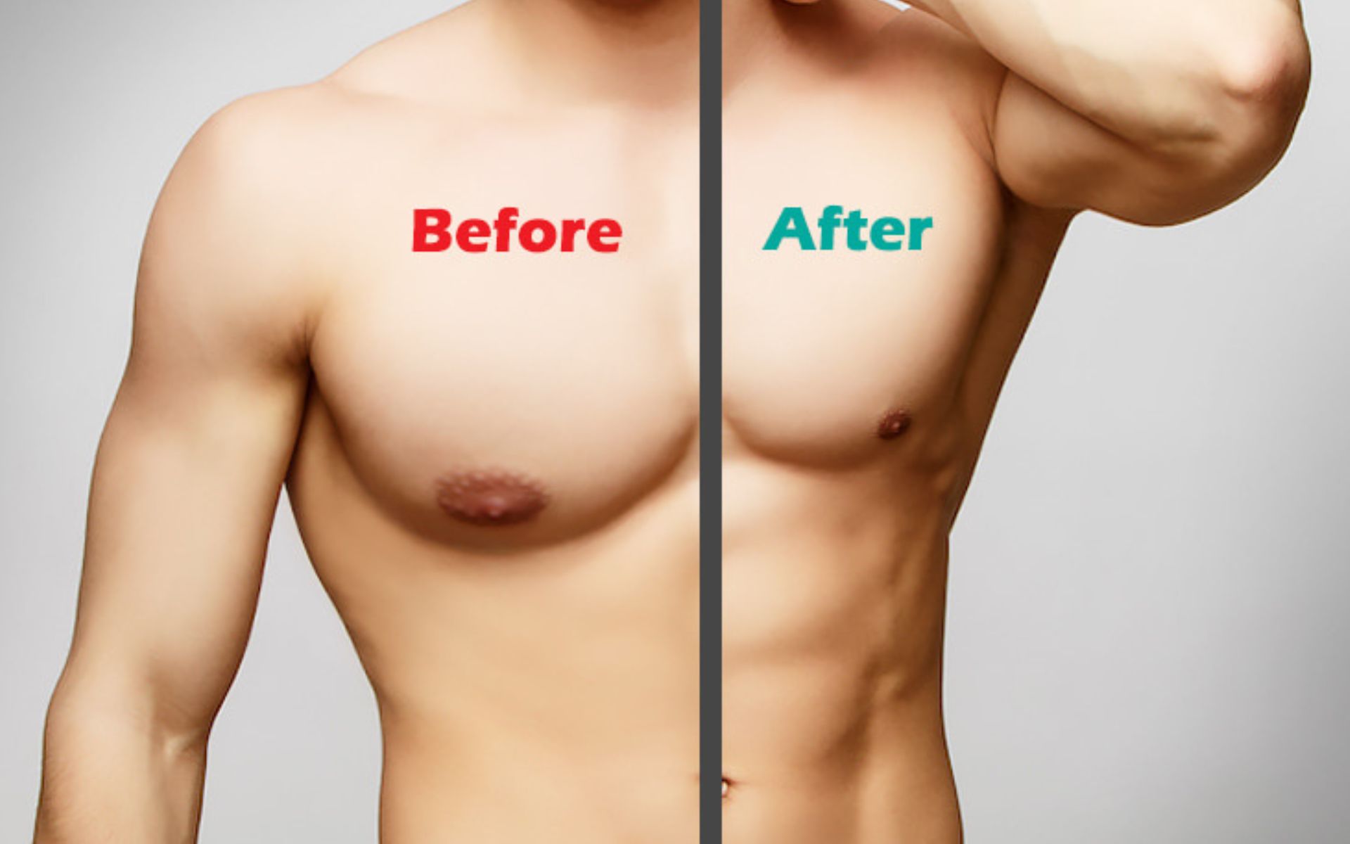 Gynecomastia Surgery: A Complete Guide to Male Breast Reduction