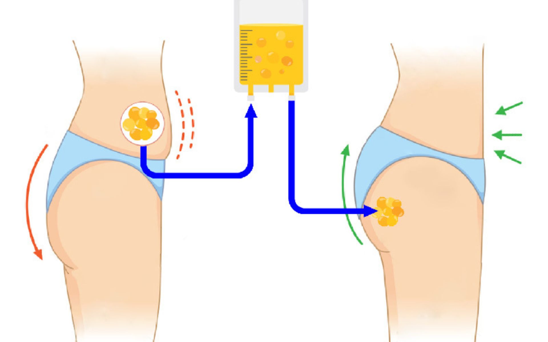 Silicone Butt Implants Benefits, Procedure, Recovery & Results