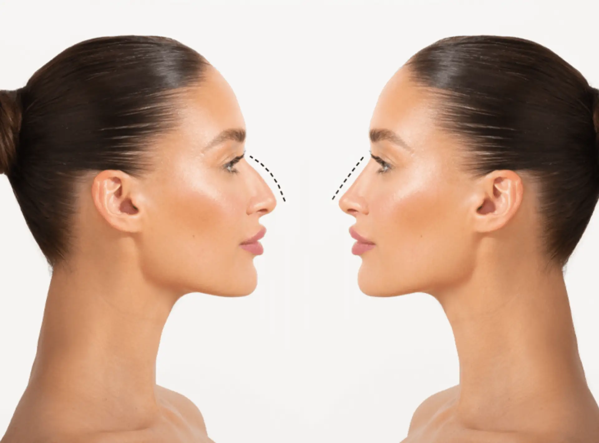 Rhinoplasty Surgery: Benefits, Procedure, Recovery & Expected Results