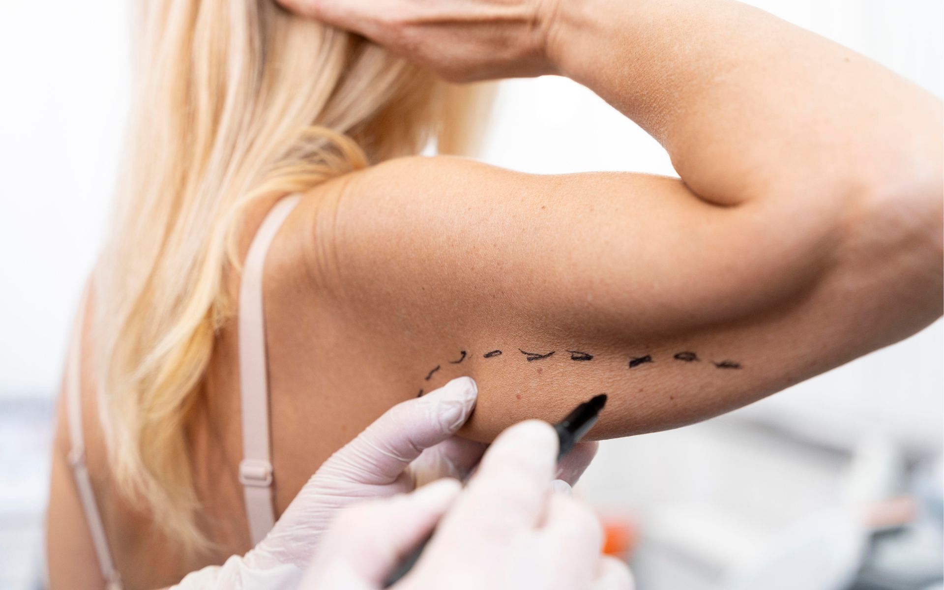 Arm Lift Surgery Brachioplasty, Recovery & Results