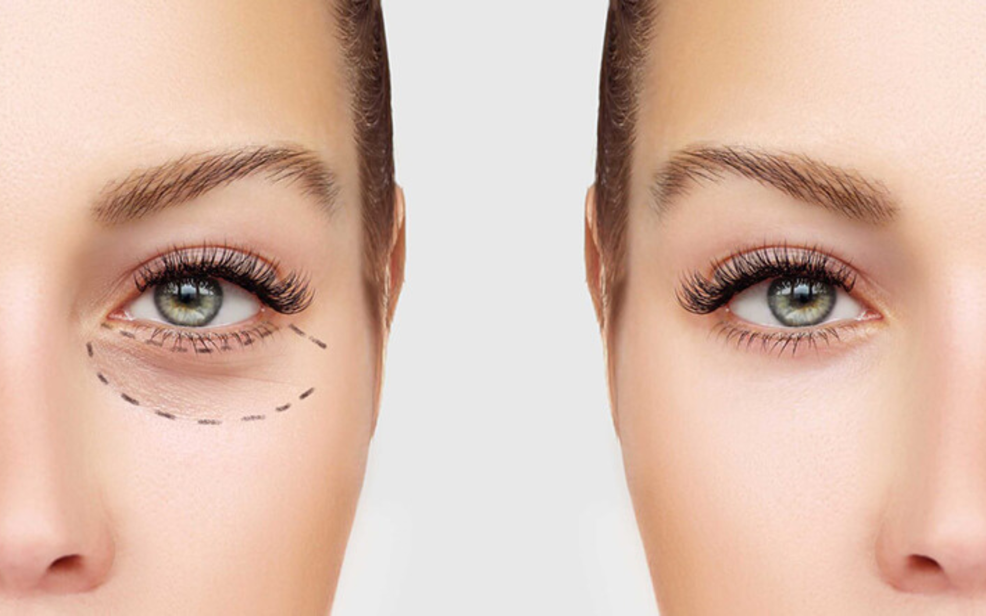 Blepharoplasty Surgery: Eyelid Rejuvenation for a Fresher, Younger Look