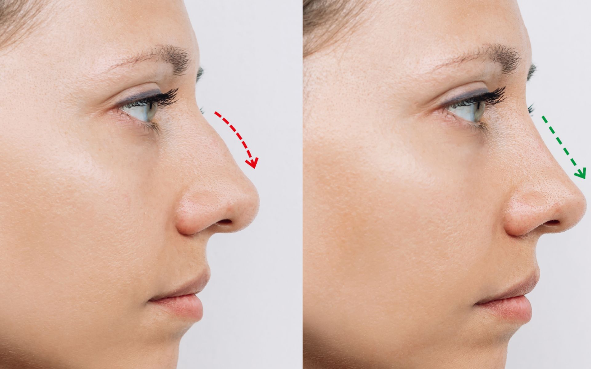 Rhinoplasty vs Septorhinoplasty in Key Differences