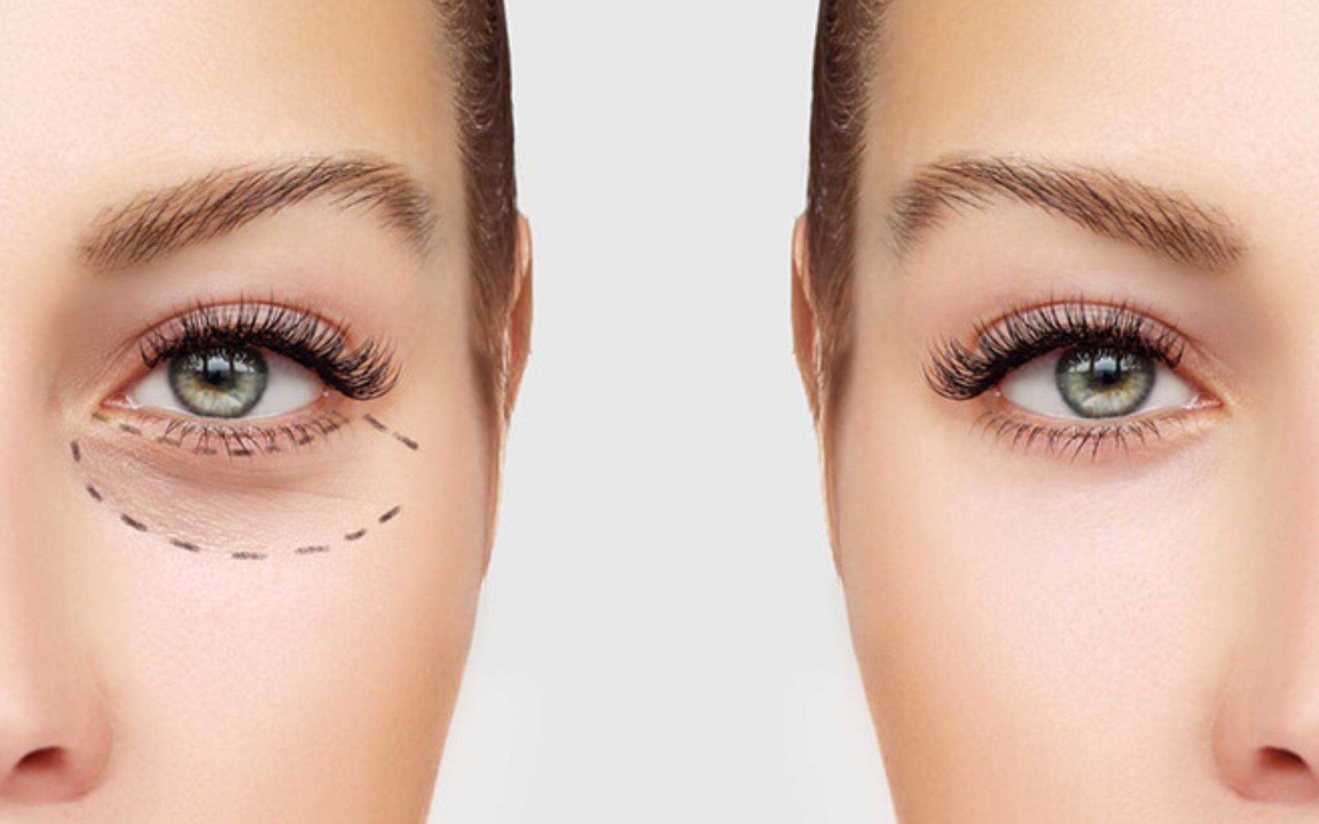Blepharoplasty Droopy Eyelid Surgery Guide