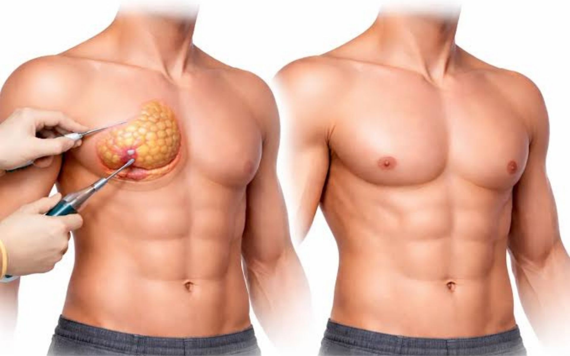Male Breast Reduction Gynecomastia Surgery Guide