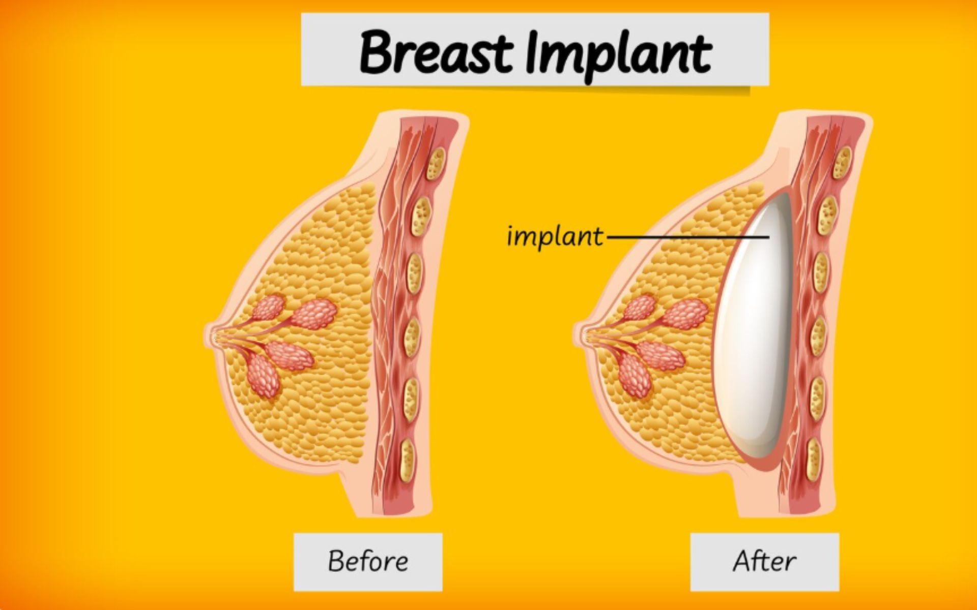 Capsular Contracture After Breast Implants Causes & Treatment