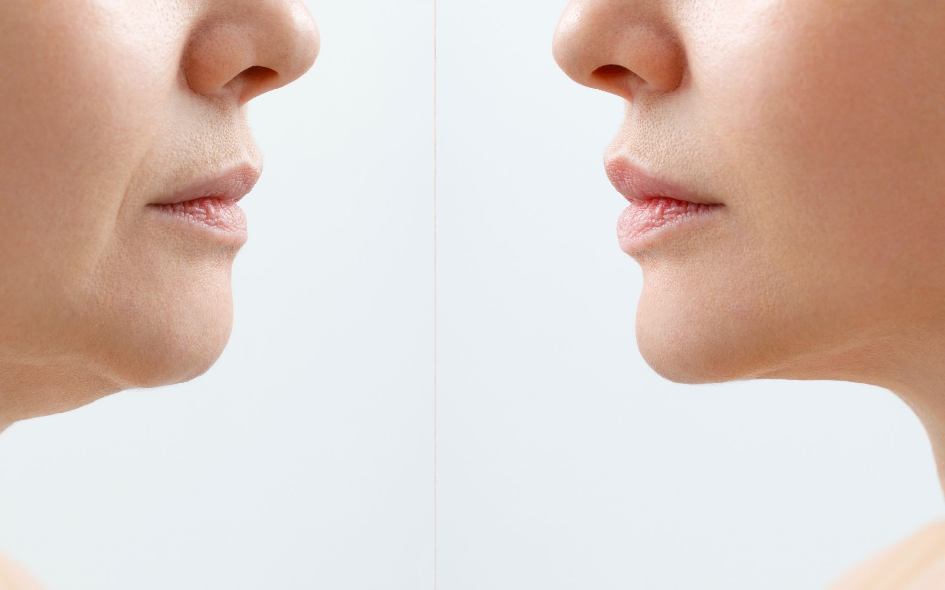 Double Chin Treatment Liposuction vs Neck Lift