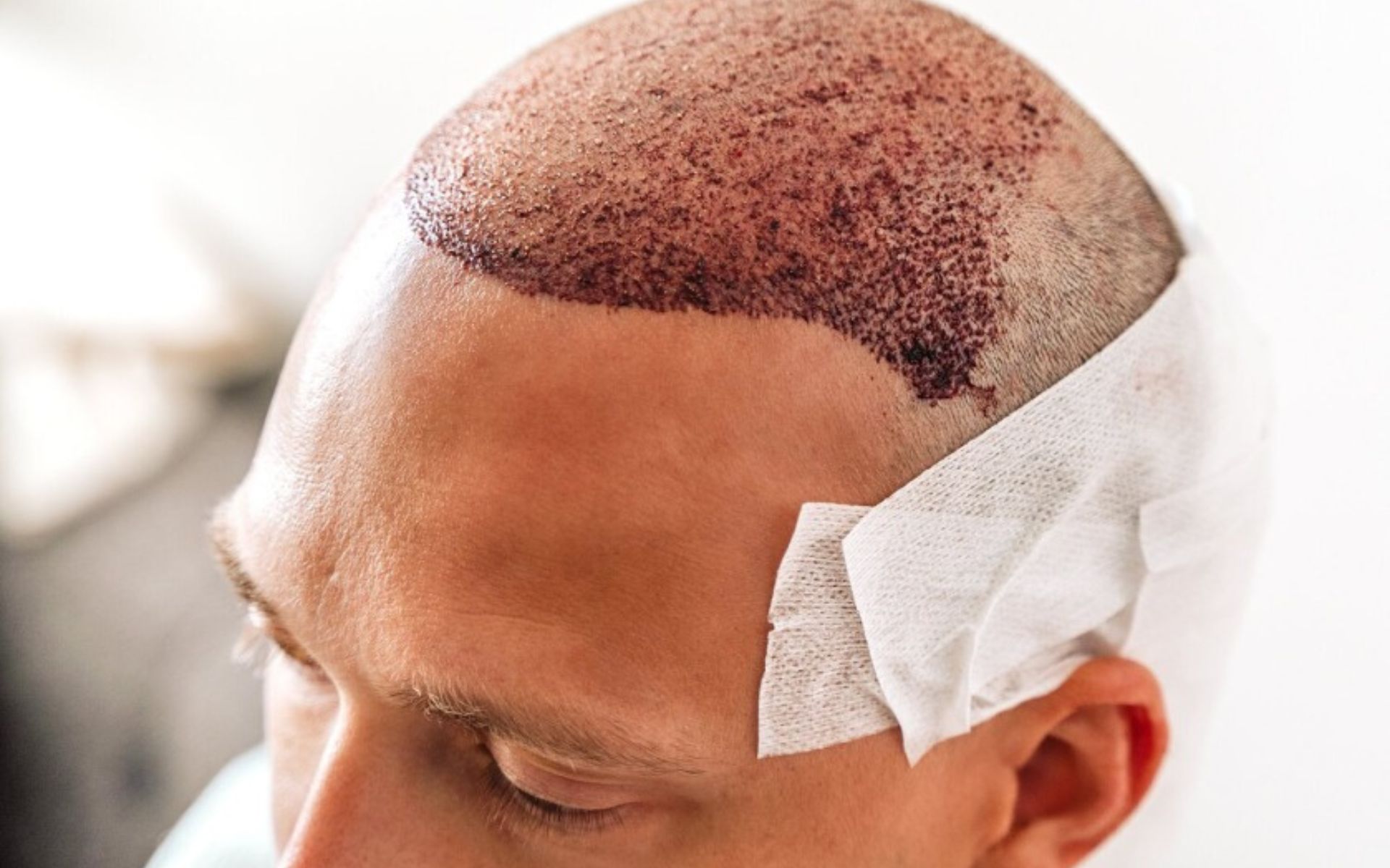 Hair Transplant Repair Fixing a Bad or Failed Transplant
