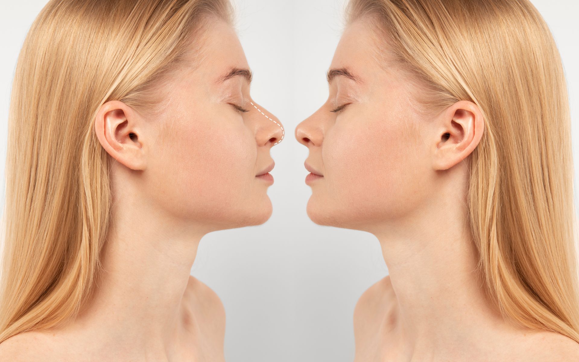 Revision Rhinoplasty Correcting a Previous Nose Job.